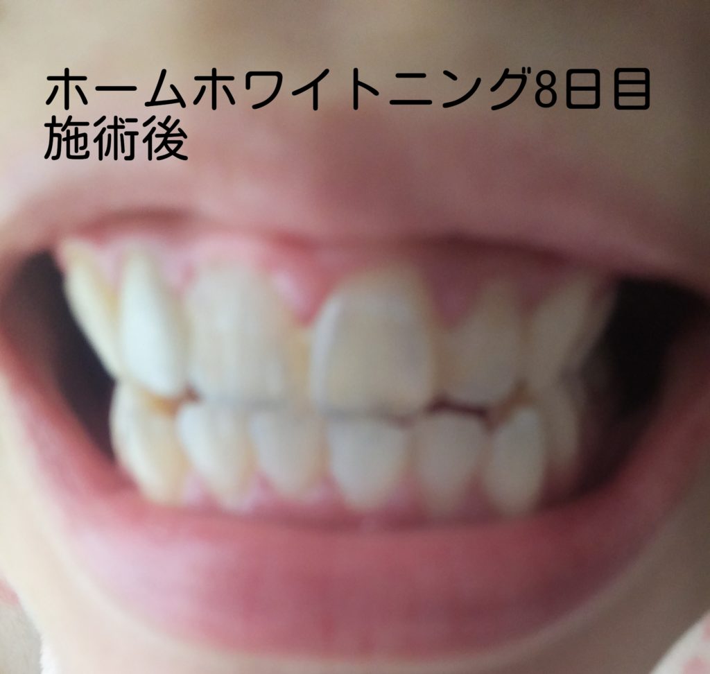 湘南美容歯科 ホームホワイトニング日記 るーじゅの体験レポート